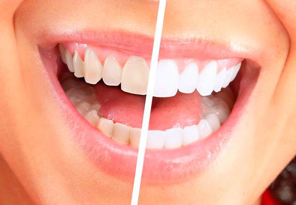 Вот как можно устранить зубной камень и отбелить зубы за 4 минуты! Совет от практикующего стоматолога