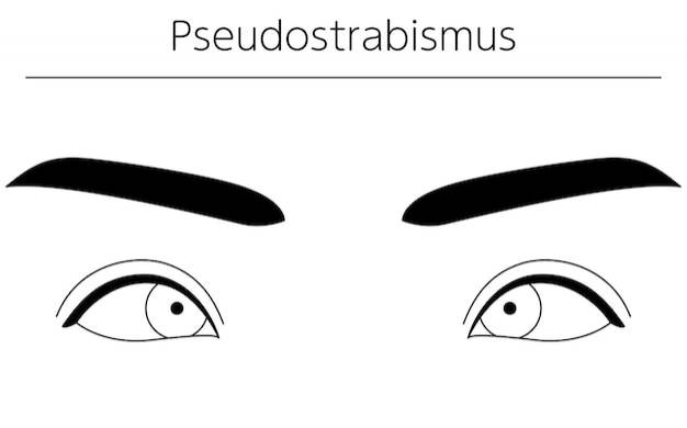 Медицинские иллюстрации схематических рисунков глазных болезней косоглазия и псевдокосоглазия