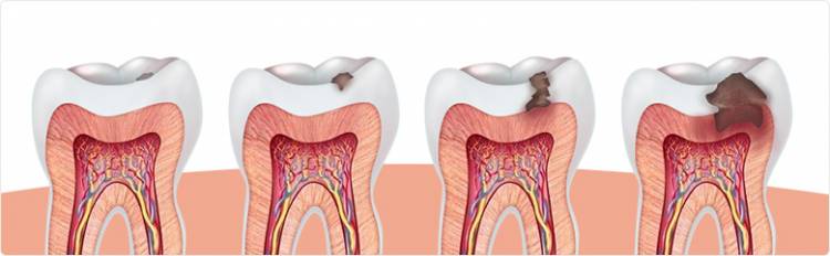Стадии кариеса зубов у детей